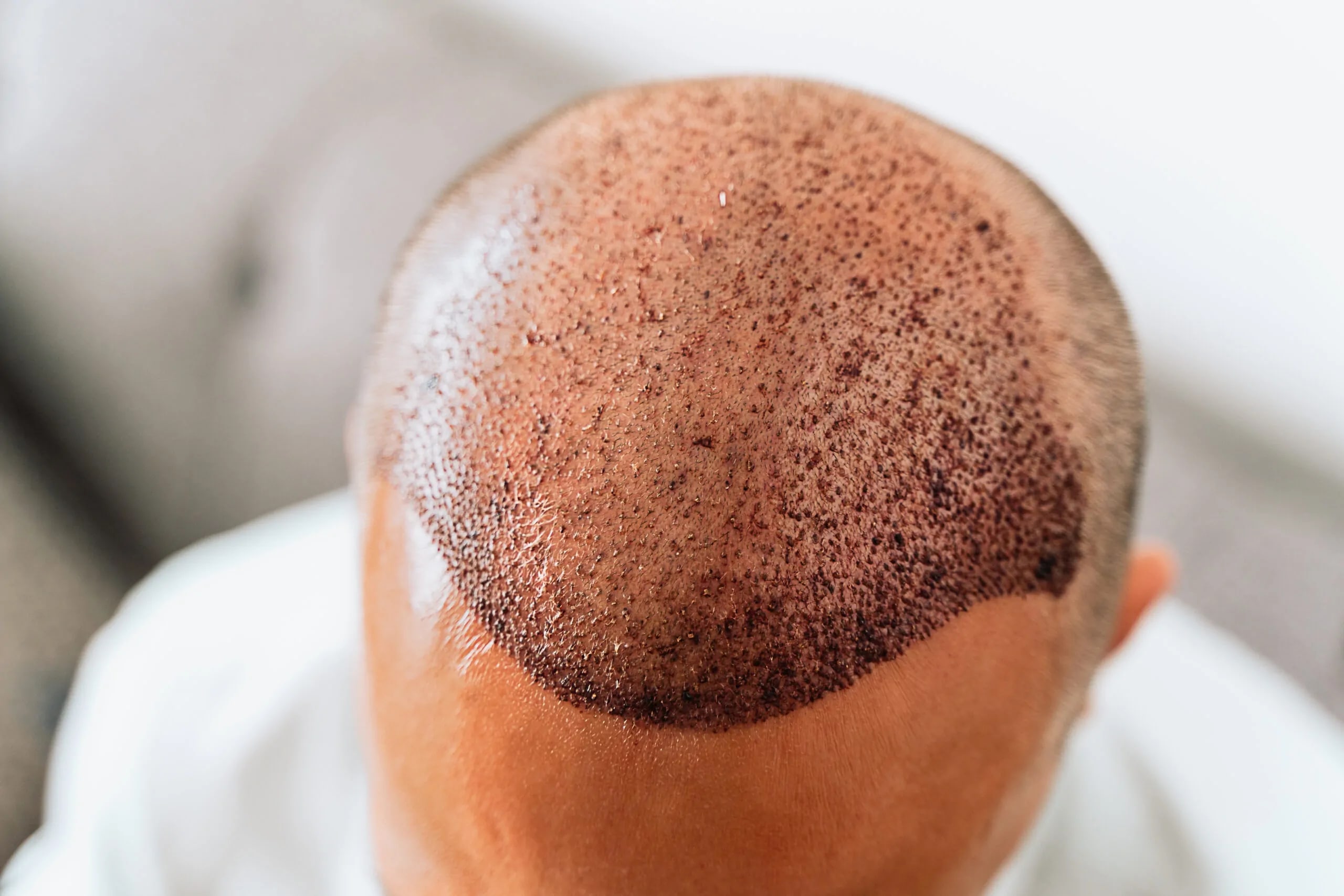 Hair transplant before and after results